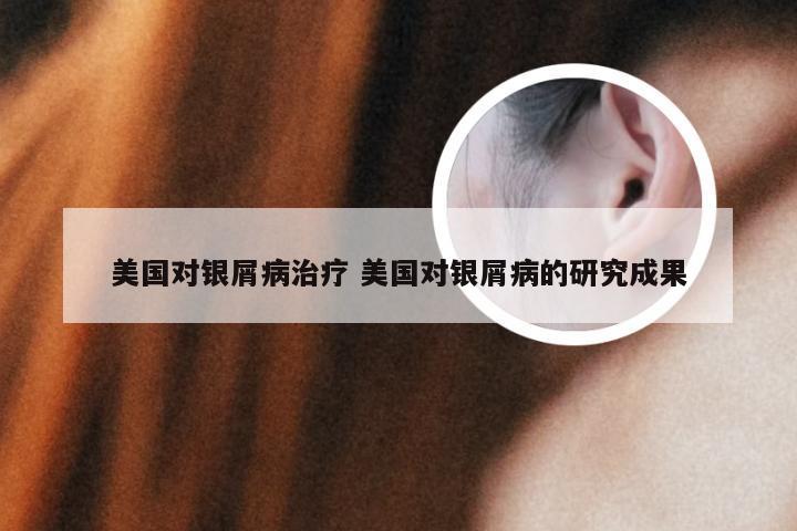 美国对银屑病治疗 美国对银屑病的研究成果
