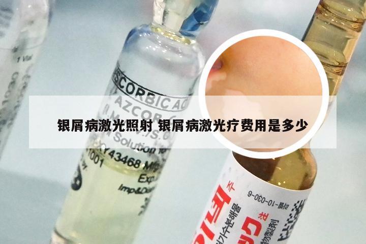 银屑病激光照射 银屑病激光疗费用是多少