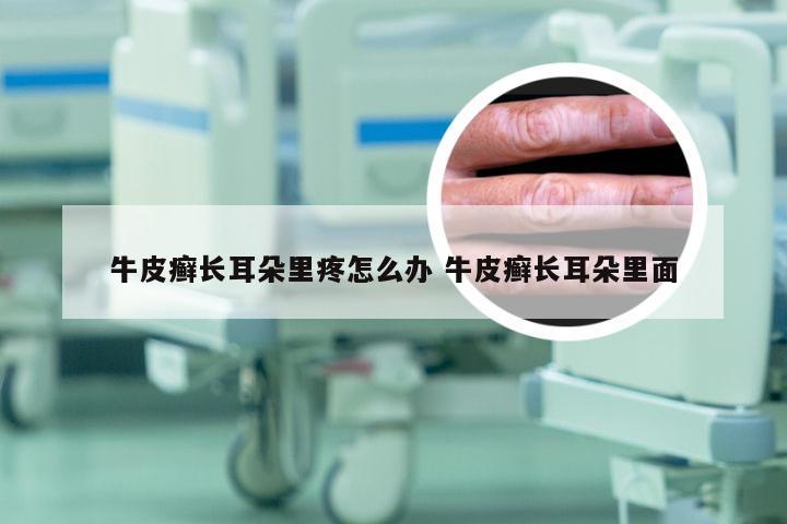 牛皮癣长耳朵里疼怎么办 牛皮癣长耳朵里面