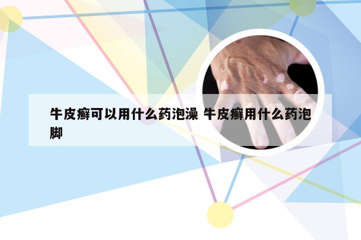 牛皮癣可以用什么药泡澡 牛皮癣用什么药泡脚