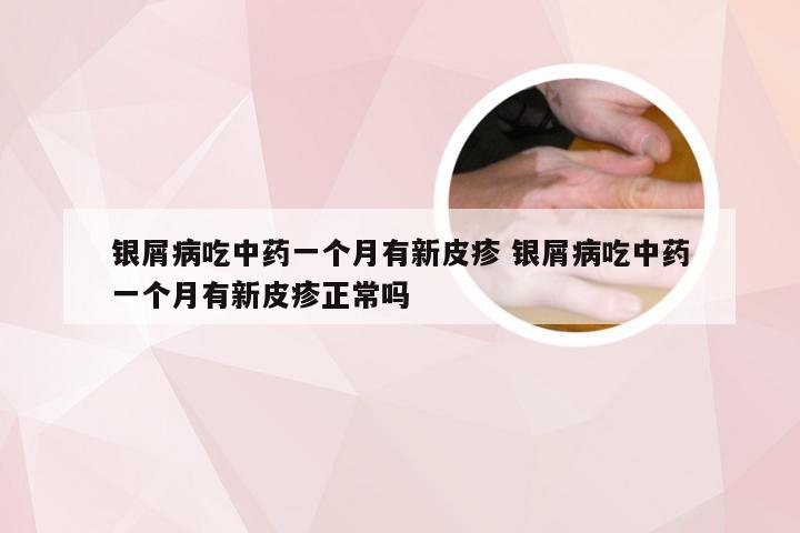银屑病吃中药一个月有新皮疹 银屑病吃中药一个月有新皮疹正常吗