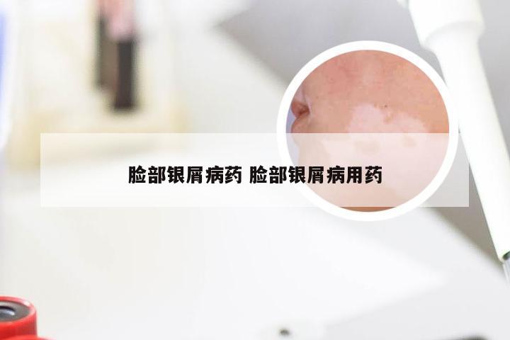 脸部银屑病药 脸部银屑病用药