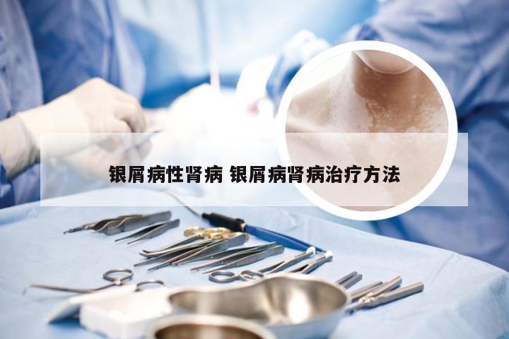 银屑病性肾病 银屑病肾病治疗方法