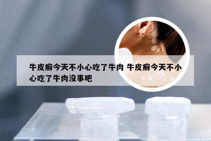 牛皮癣今天不小心吃了牛肉 牛皮癣今天不小心吃了牛肉没事吧
