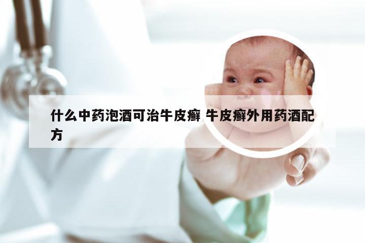 什么中药泡酒可治牛皮癣 牛皮癣外用药酒配方