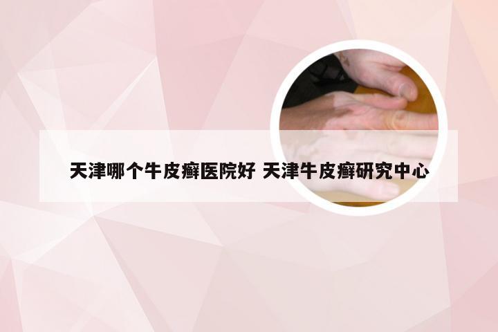 天津哪个牛皮癣医院好 天津牛皮癣研究中心
