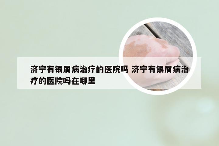 济宁有银屑病治疗的医院吗 济宁有银屑病治疗的医院吗在哪里