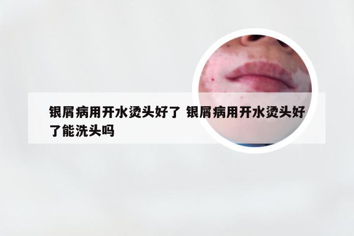 银屑病用开水烫头好了 银屑病用开水烫头好了能洗头吗