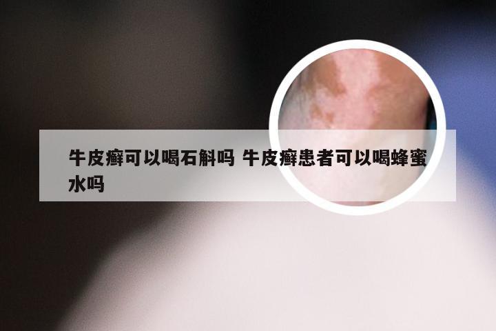 牛皮癣可以喝石斛吗 牛皮癣患者可以喝蜂蜜水吗
