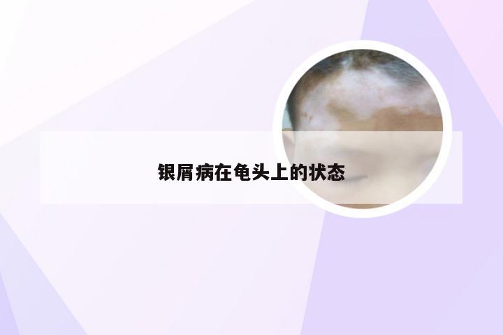 银屑病在龟头上的状态