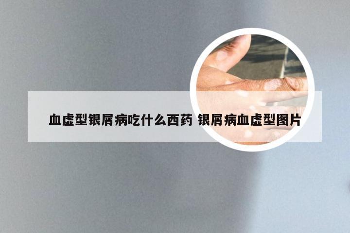 血虚型银屑病吃什么西药 银屑病血虚型图片
