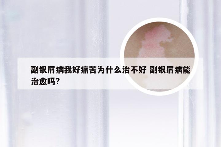副银屑病我好痛苦为什么治不好 副银屑病能治愈吗?