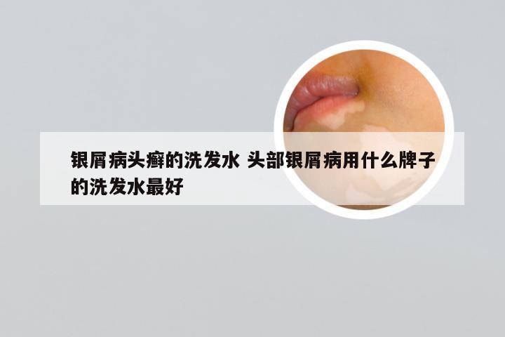 银屑病头癣的洗发水 头部银屑病用什么牌子的洗发水最好