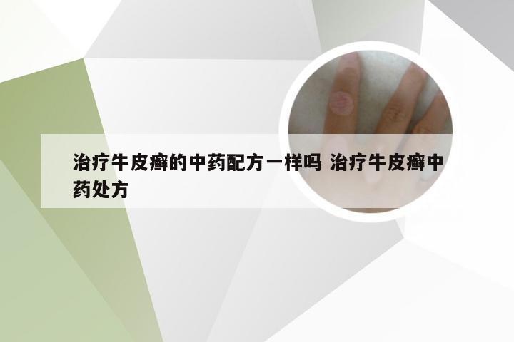 治疗牛皮癣的中药配方一样吗 治疗牛皮癣中药处方
