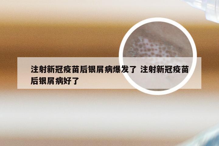 注射新冠疫苗后银屑病爆发了 注射新冠疫苗后银屑病好了