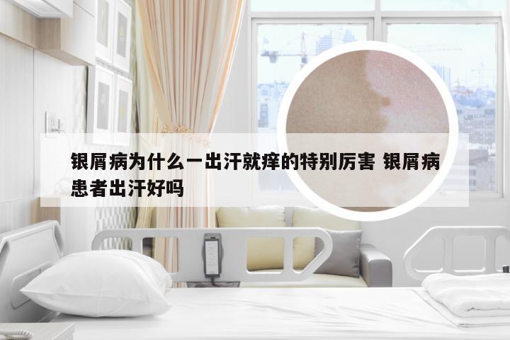 银屑病为什么一出汗就痒的特别厉害 银屑病患者出汗好吗