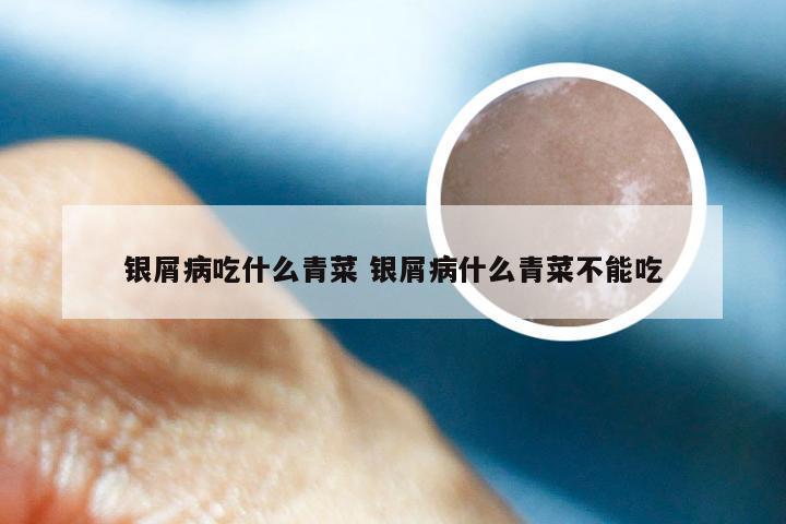 银屑病吃什么青菜 银屑病什么青菜不能吃