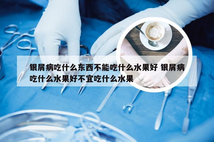 银屑病吃什么东西不能吃什么水果好 银屑病吃什么水果好不宜吃什么水果