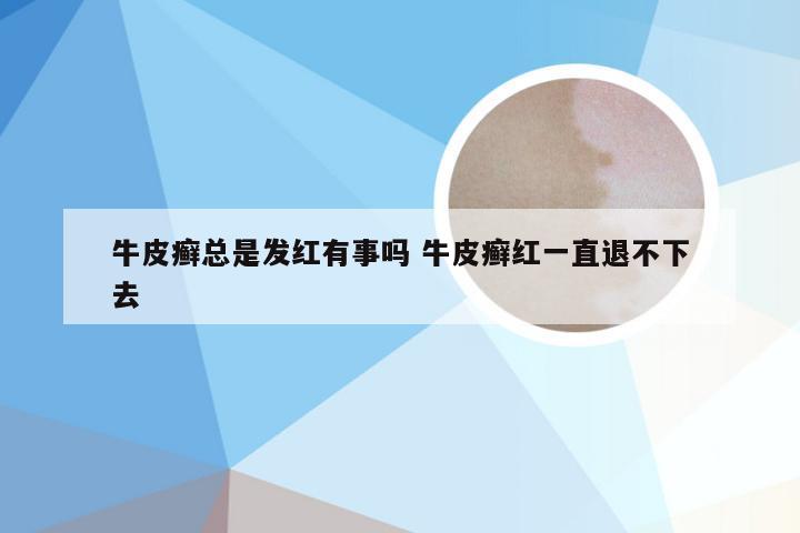 牛皮癣总是发红有事吗 牛皮癣红一直退不下去