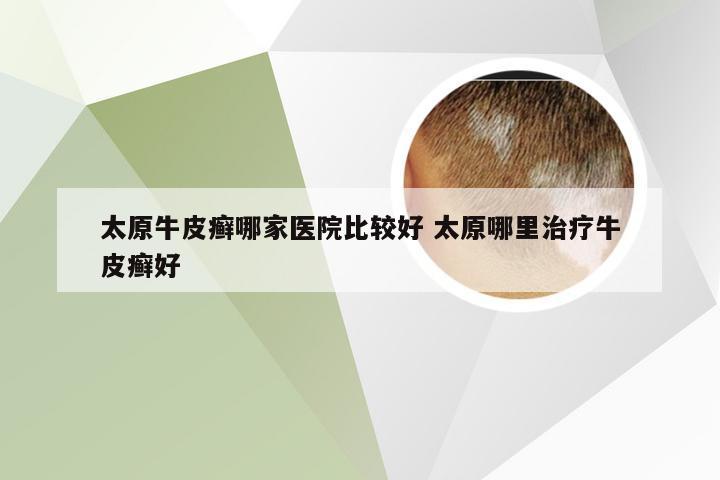 太原牛皮癣哪家医院比较好 太原哪里治疗牛皮癣好