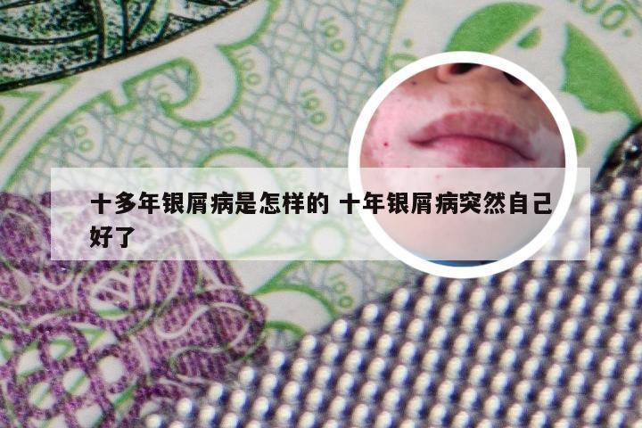十多年银屑病是怎样的 十年银屑病突然自己好了