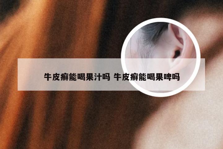 牛皮癣能喝果汁吗 牛皮癣能喝果啤吗
