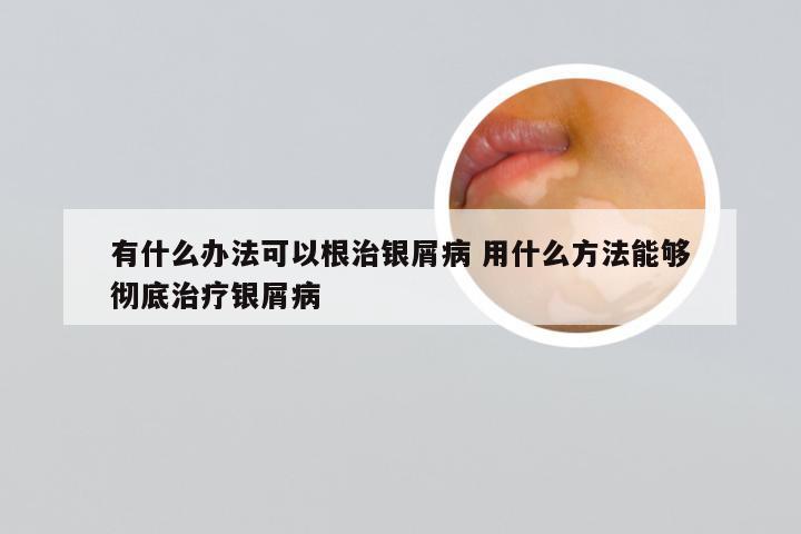 有什么办法可以根治银屑病 用什么方法能够彻底治疗银屑病