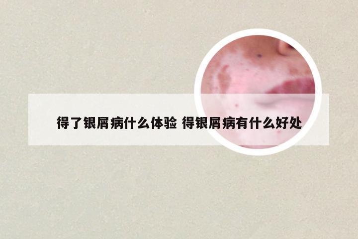 得了银屑病什么体验 得银屑病有什么好处