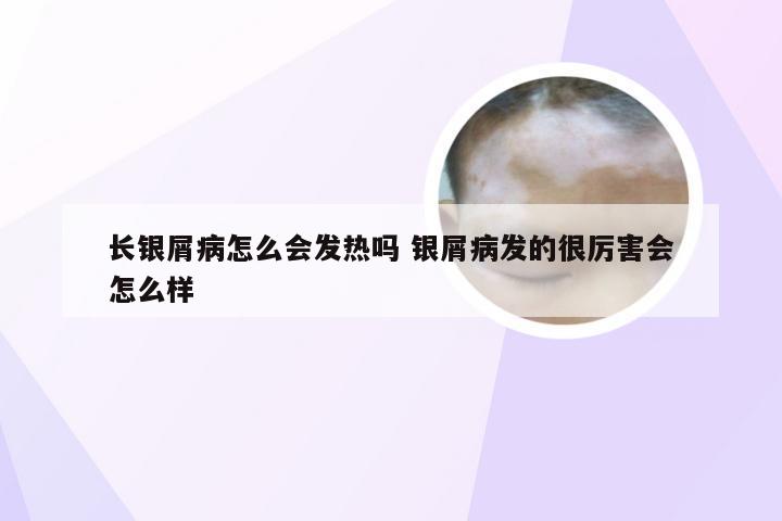 长银屑病怎么会发热吗 银屑病发的很厉害会怎么样