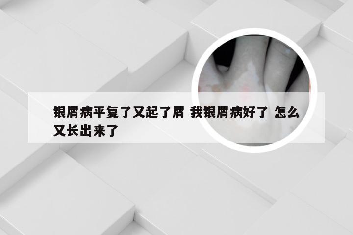 银屑病平复了又起了屑 我银屑病好了 怎么又长出来了