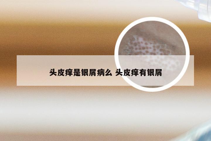 头皮痒是银屑病么 头皮痒有银屑