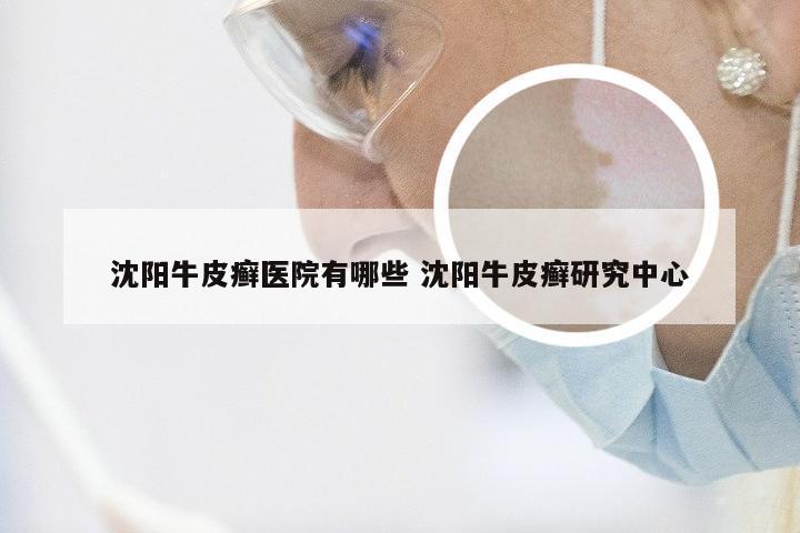 沈阳牛皮癣医院有哪些 沈阳牛皮癣研究中心