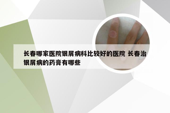长春哪家医院银屑病科比较好的医院 长春治银屑病的药膏有哪些
