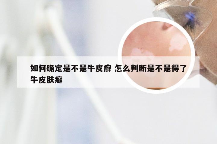 如何确定是不是牛皮癣 怎么判断是不是得了牛皮肤癣