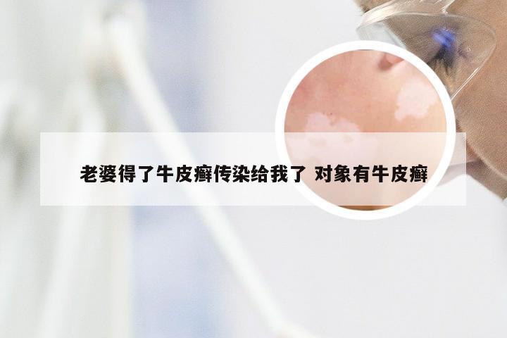 老婆得了牛皮癣传染给我了 对象有牛皮癣
