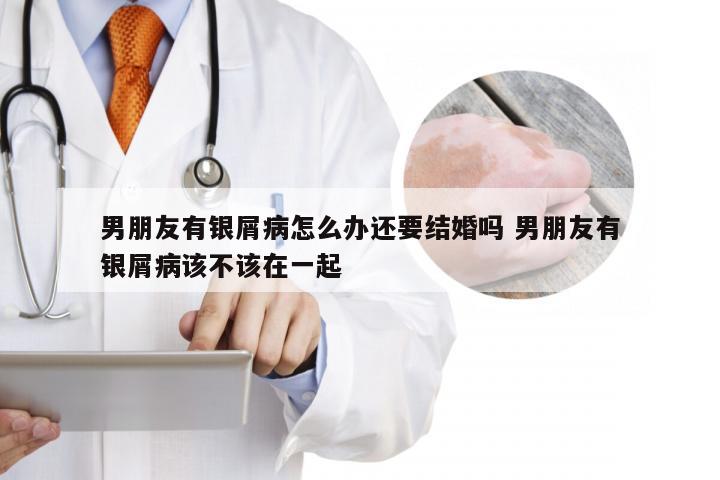 男朋友有银屑病怎么办还要结婚吗 男朋友有银屑病该不该在一起