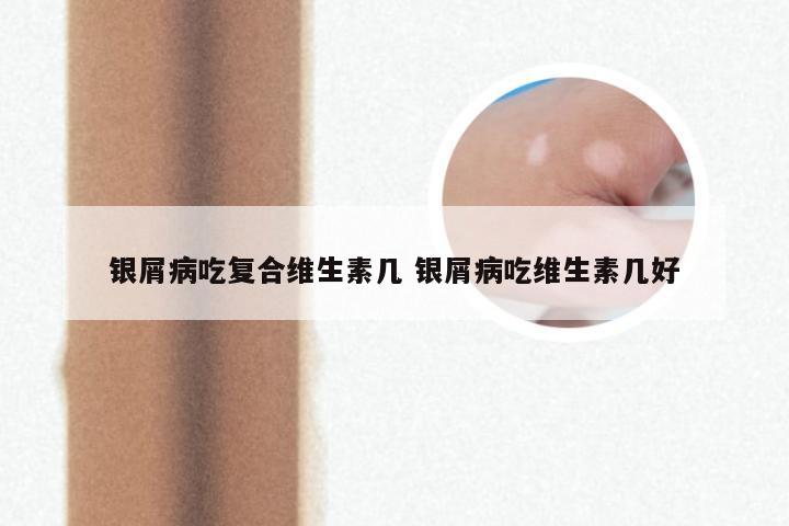 银屑病吃复合维生素几 银屑病吃维生素几好