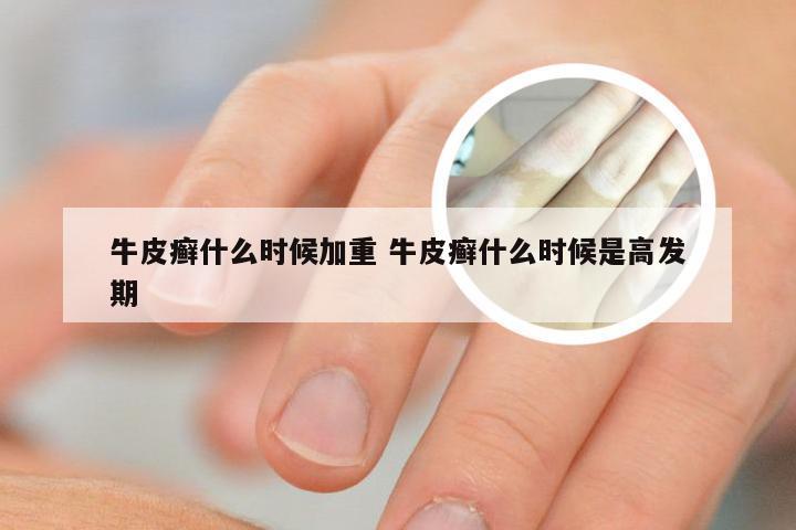 牛皮癣什么时候加重 牛皮癣什么时候是高发期