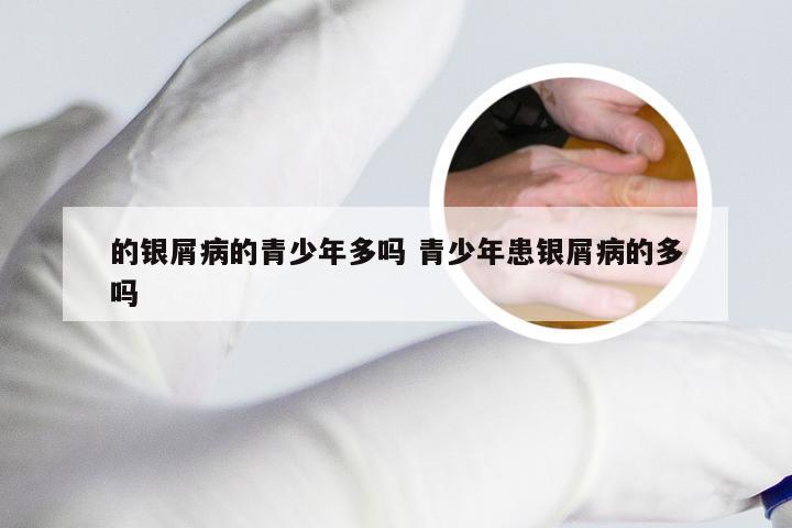 的银屑病的青少年多吗 青少年患银屑病的多吗