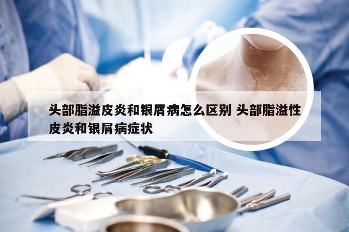 头部脂溢皮炎和银屑病怎么区别 头部脂溢性皮炎和银屑病症状