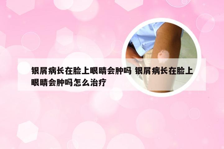 银屑病长在脸上眼睛会肿吗 银屑病长在脸上眼睛会肿吗怎么治疗