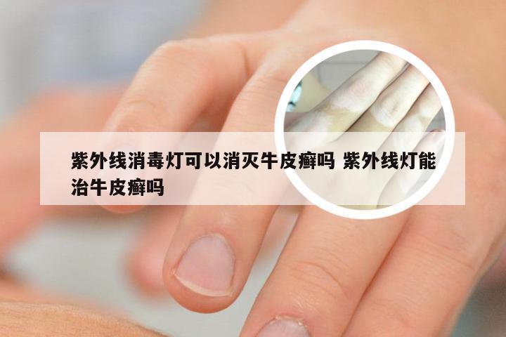 紫外线消毒灯可以消灭牛皮癣吗 紫外线灯能治牛皮癣吗