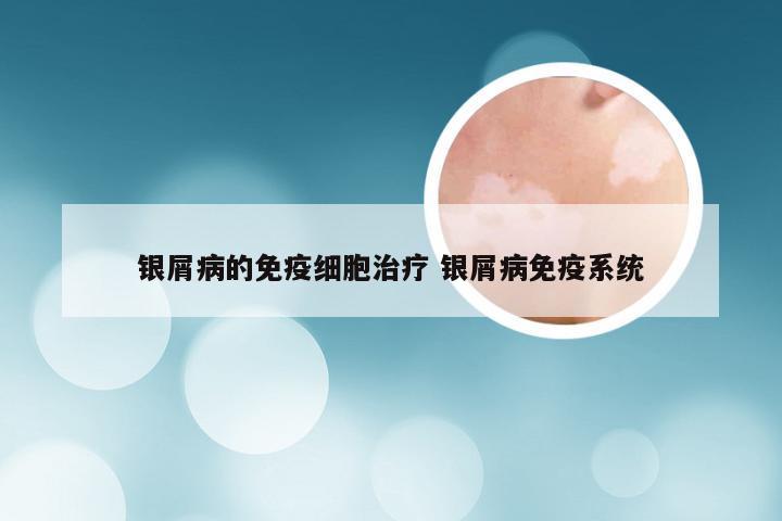 银屑病的免疫细胞治疗 银屑病免疫系统