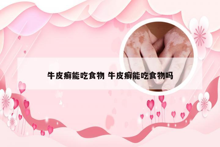 牛皮癣能吃食物 牛皮癣能吃食物吗