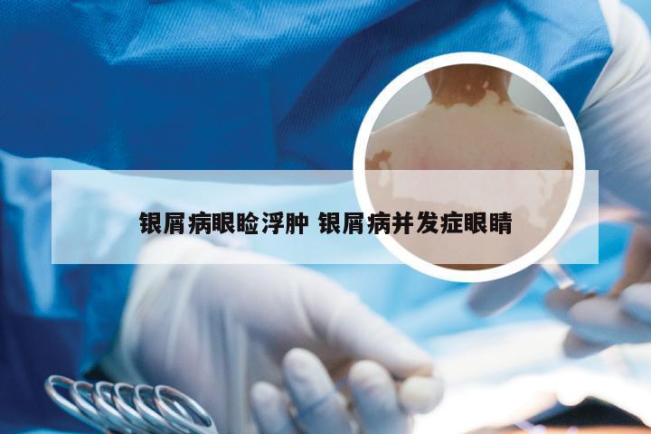 银屑病眼睑浮肿 银屑病并发症眼睛