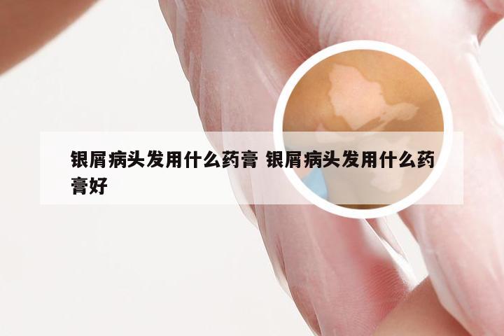 银屑病头发用什么药膏 银屑病头发用什么药膏好