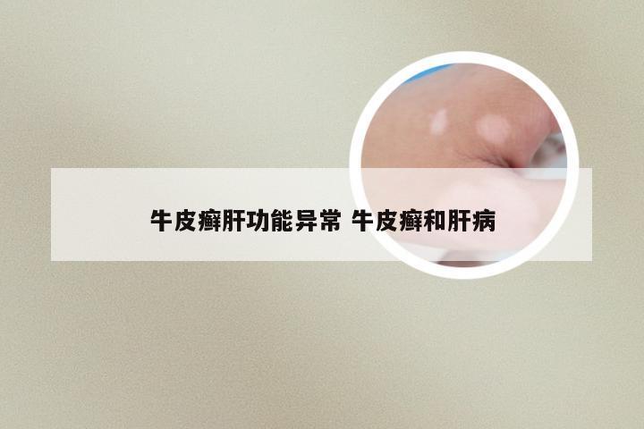 牛皮癣肝功能异常 牛皮癣和肝病