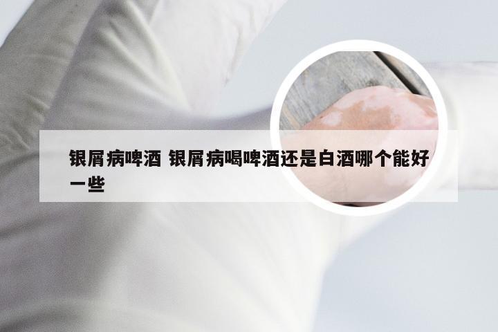 银屑病啤酒 银屑病喝啤酒还是白酒哪个能好一些
