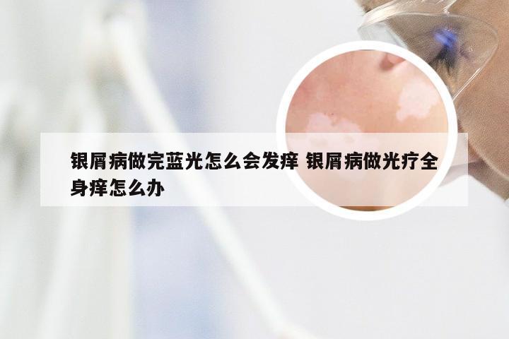 银屑病做完蓝光怎么会发痒 银屑病做光疗全身痒怎么办