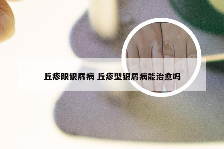 丘疹跟银屑病 丘疹型银屑病能治愈吗